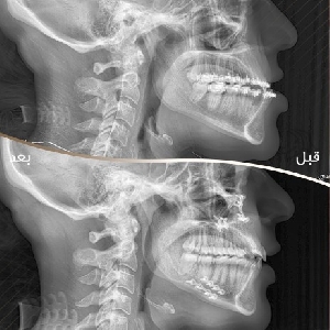 Bimaxillary Orthognathic Surgery @ Kuwait…