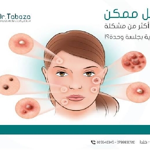 SILKPEEL Facial in Amman - Dr.Tabaza Clinic…