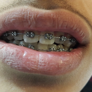 تقويم الأسنان - عيادات…
