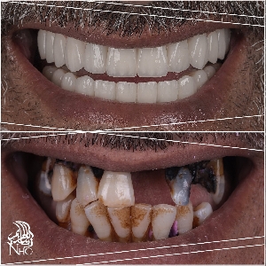 NHC Kuwait - فوائد زراعة الأسنان…